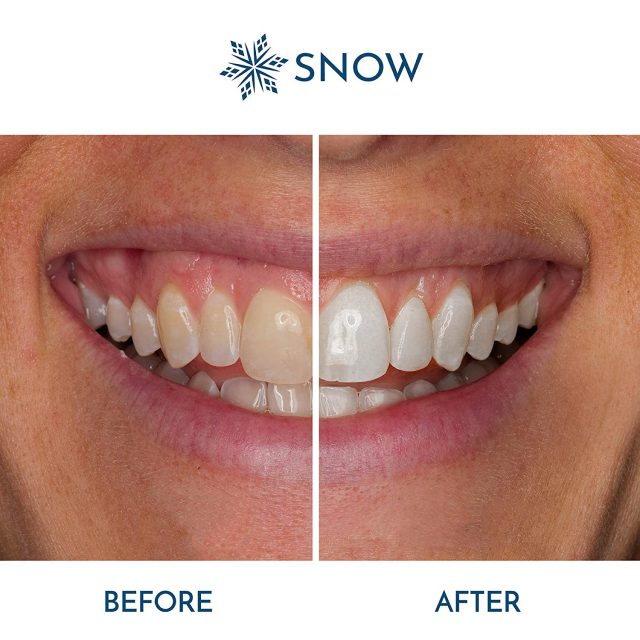 SNOW Teeth Whitening Kit with LED Light | Complete at Home Whitening System – Best Results – Safe for Sensitive Teeth, Braces, Bridges, Crowns, Caps & Veneers